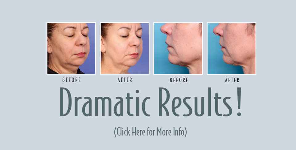 XERF - Structural Skin Tightening